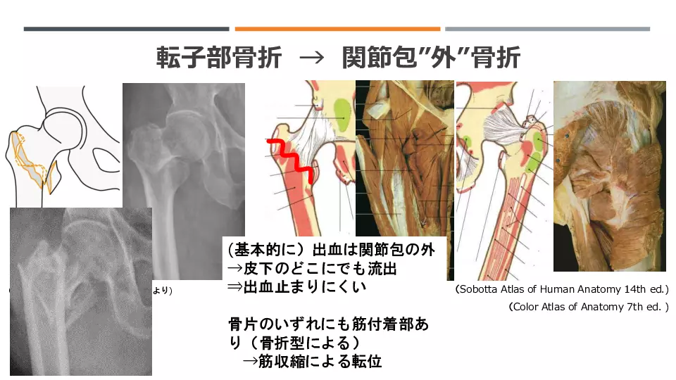 頸部骨折・転子部骨折 “違いのわかる”術後リハ | Dr.'s Prime Academia